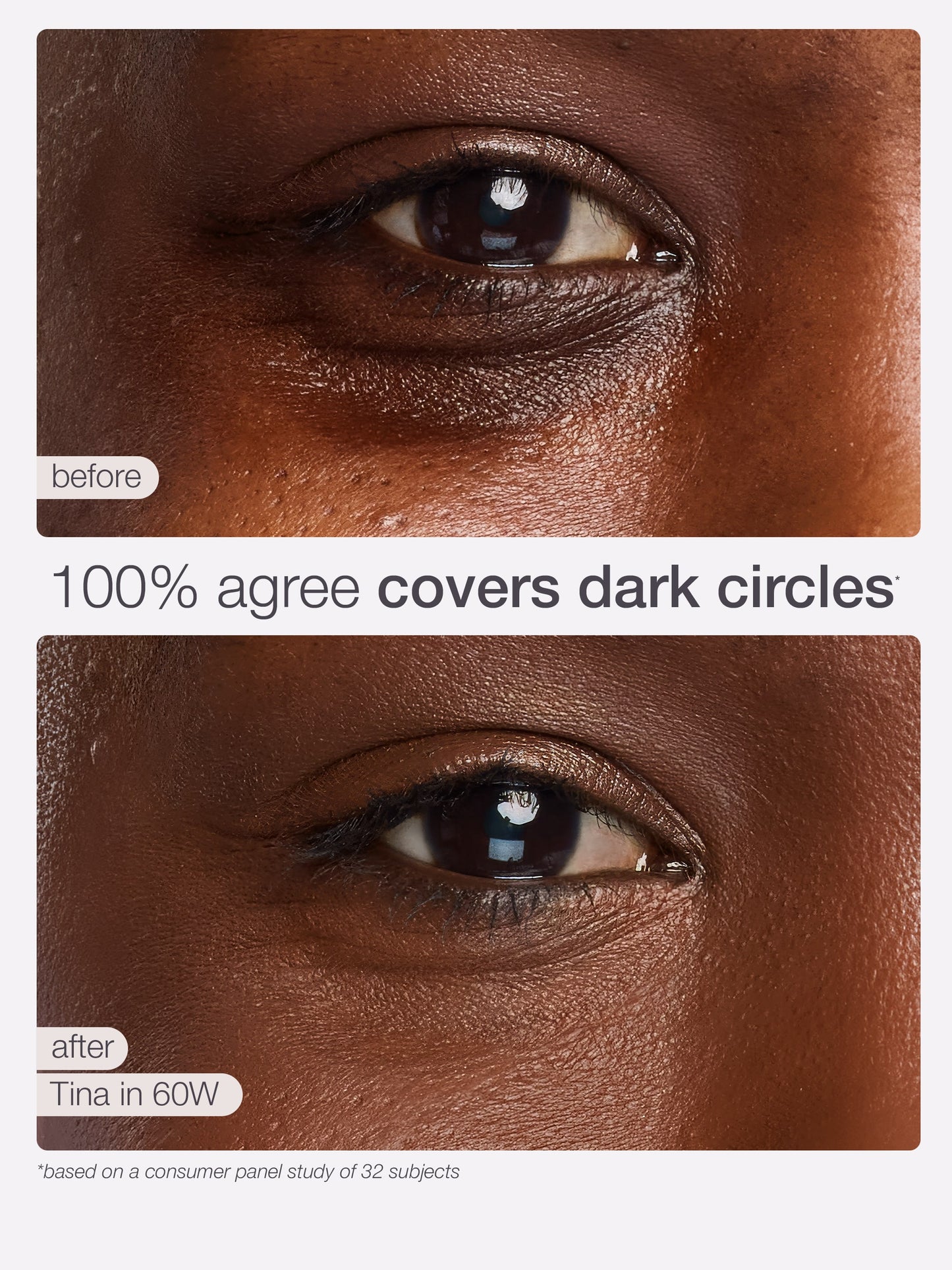 Before and after comparison of eye dark circles treatment on a person's eye.