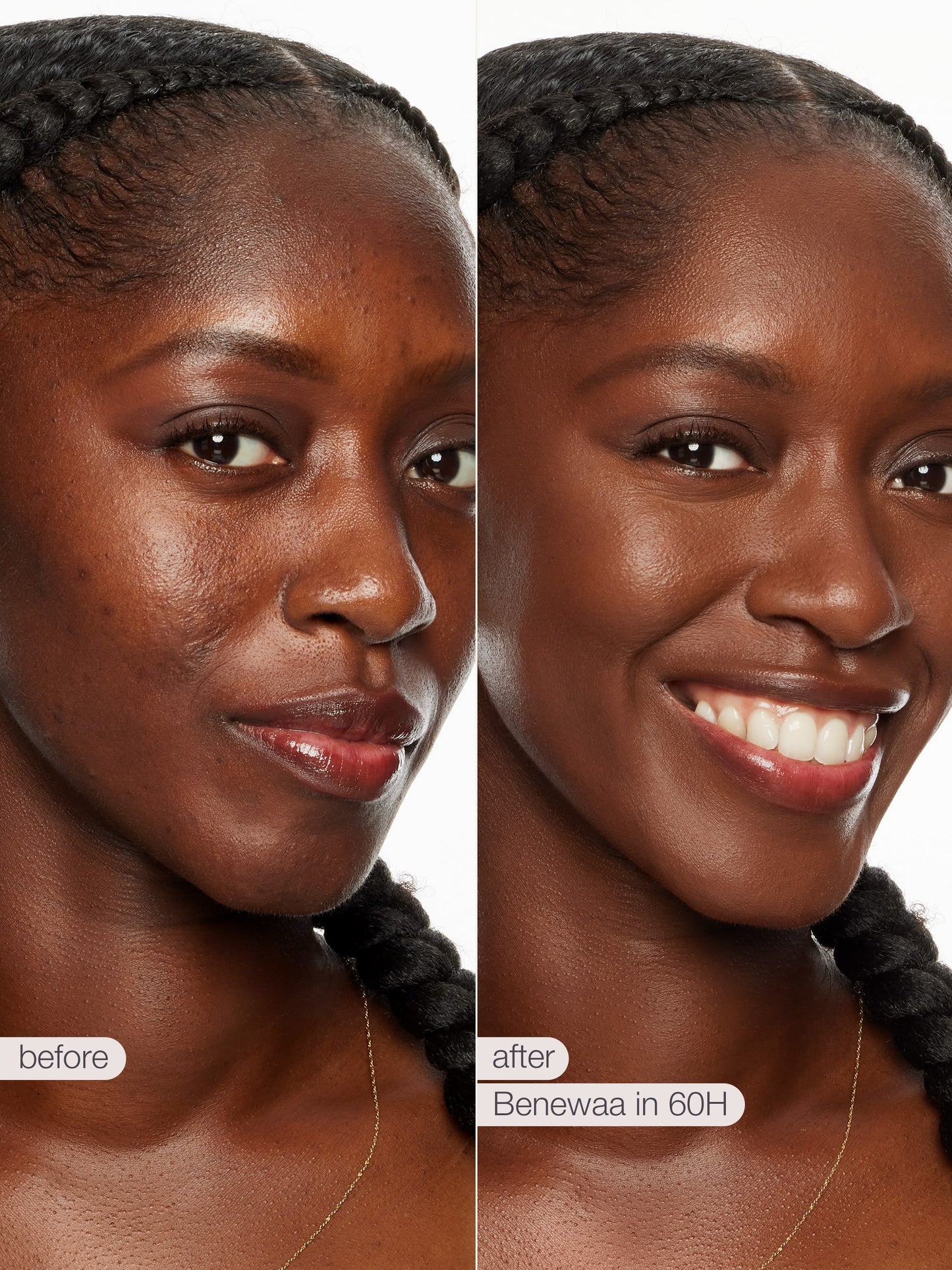 Before and after comparison of a woman's face with Benewaa skincare product application.
