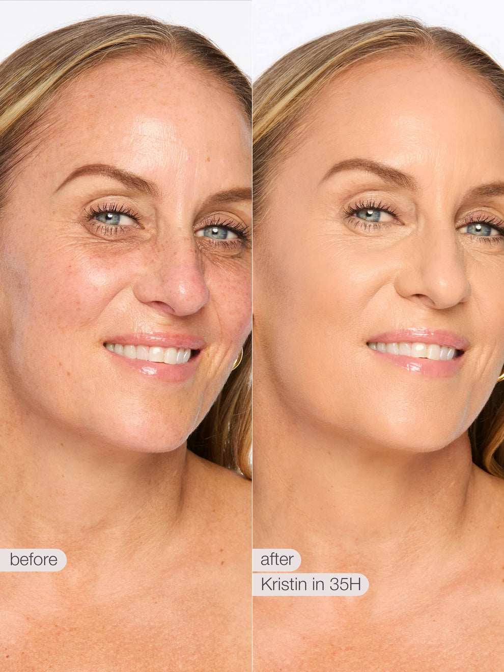 Before and after comparison of a woman's face with visible skin improvement, labeled 'Kristin' and '35H'.