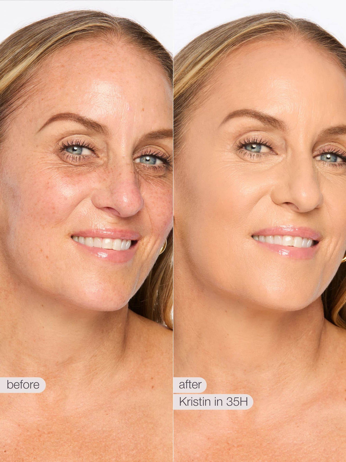 Before and after comparison of a woman's face with visible skin improvement, labeled 'Kristin' and '35H'.